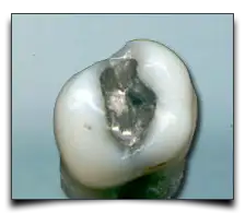 plomba z amalgamatu